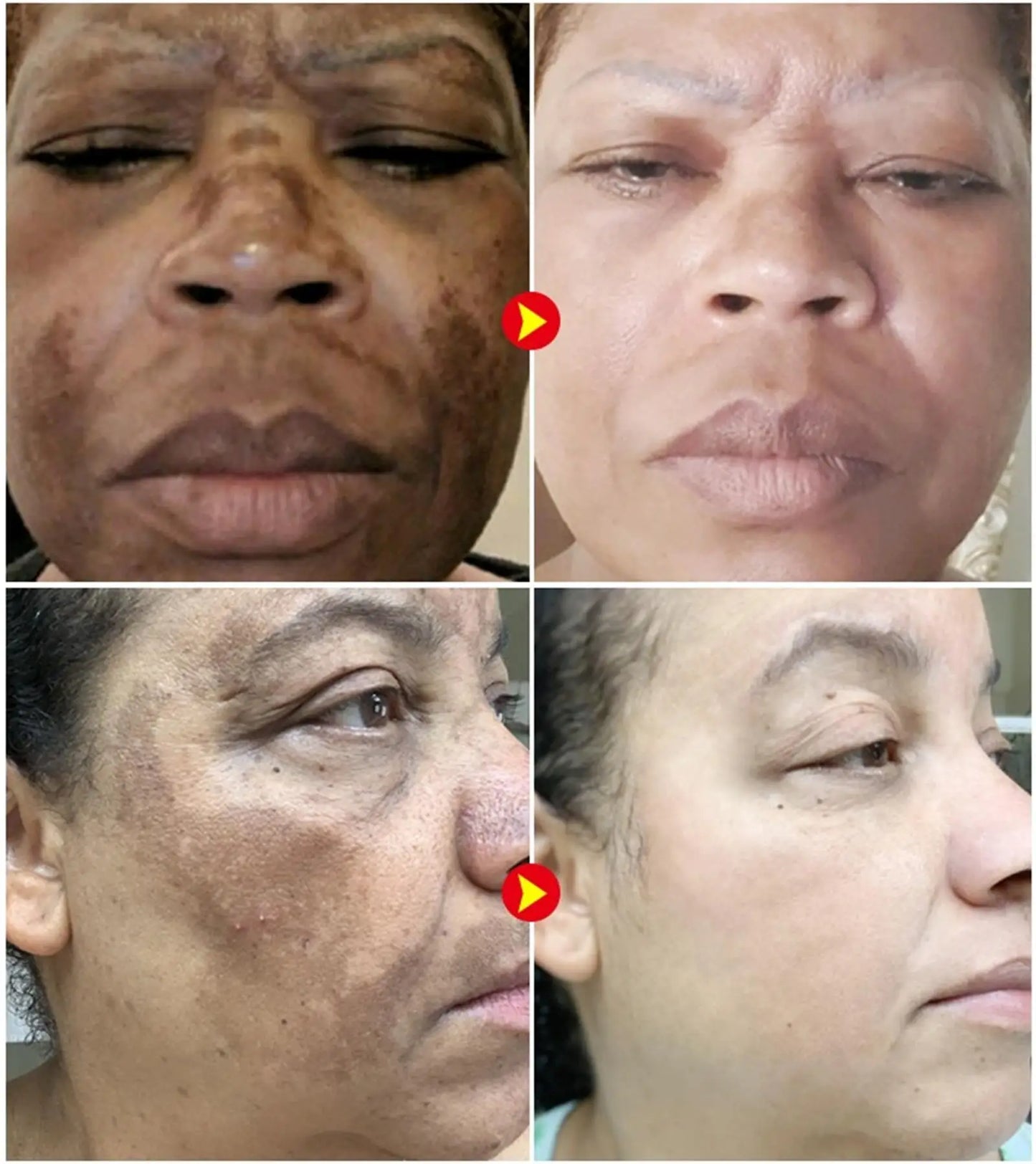 Dark Spots Remover Whitening Serum Face Freckle Melanin Correcting Anti Pigmentation Brighten Beauty Korean Day Night Skin Care